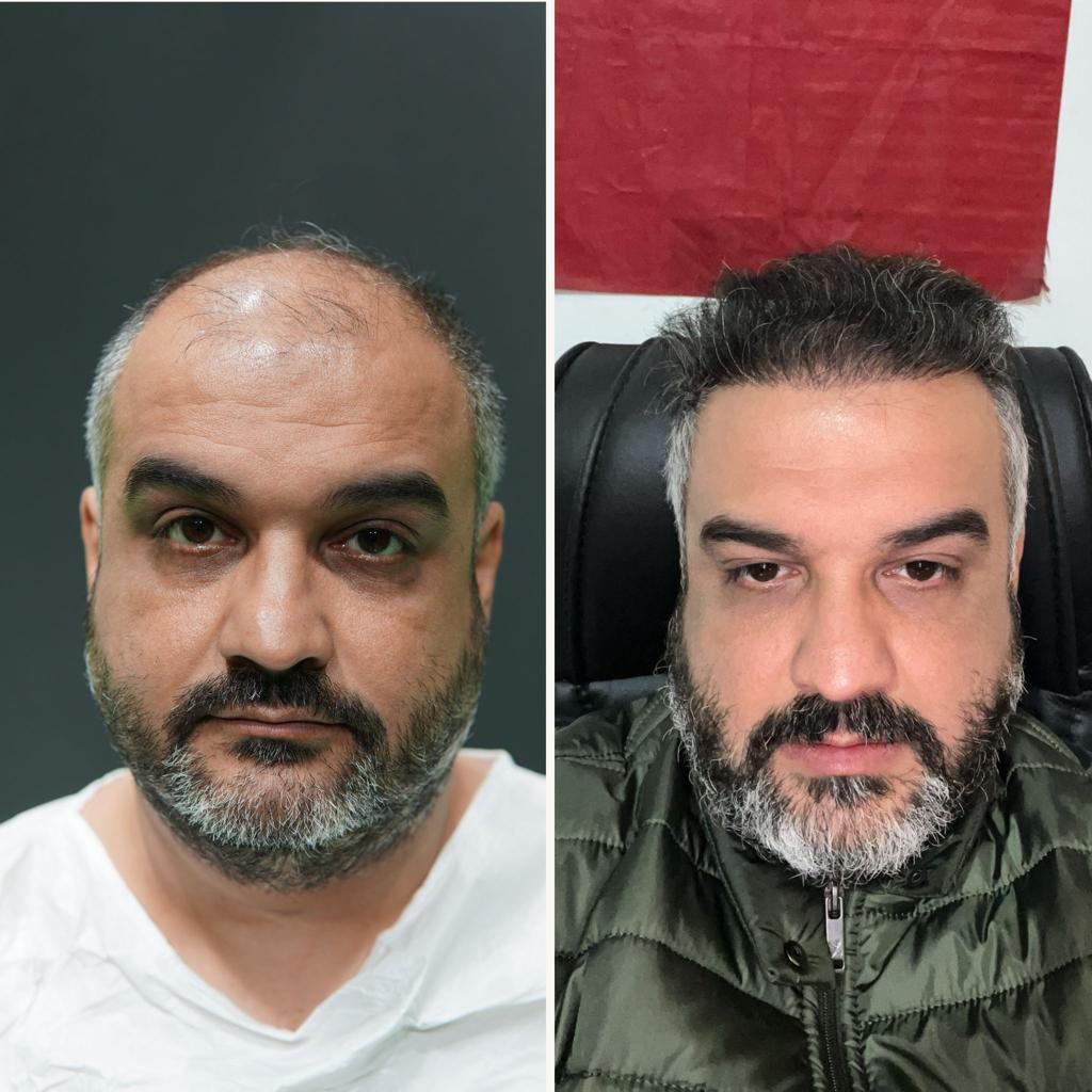 prima e dopo trapianto capelli 15